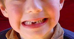 odontoiatria pediatrica, cura e prevenzione dentale fino all'adolescenza