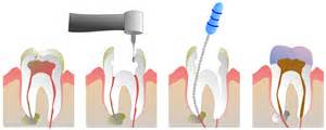 Endodonzia a Roma – soluzioni zero stress