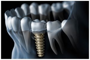 impianti dentali e prevenzione