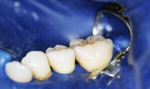 diga-di-gomma_studiodentisticodbcalef.com