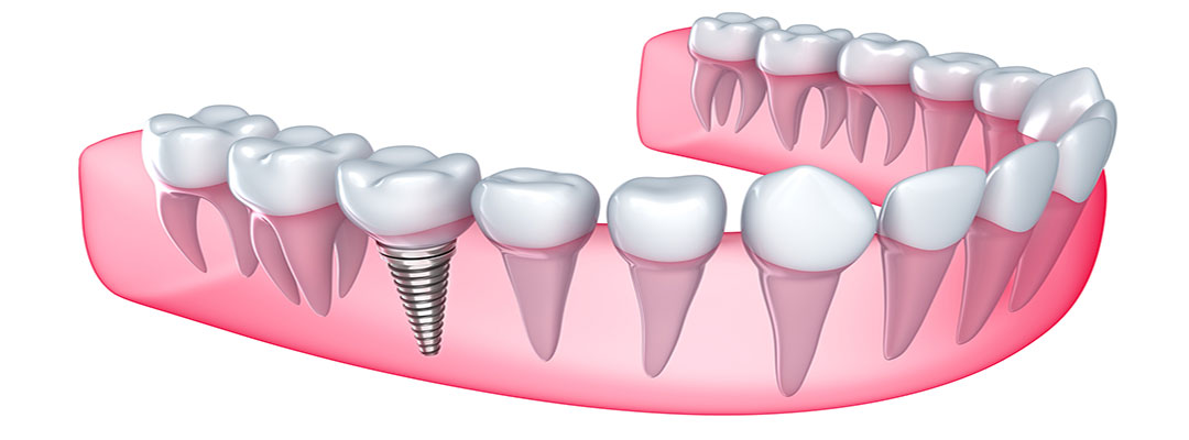 dental-implants