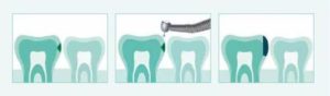 carie-dentale_studio-dentistico-db-calef-roma_studiodentisticodbcalef.com