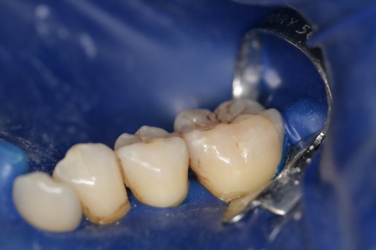 diga di gomma - studiodentisticodbcalef.com