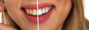 Nuove frontiere odontoiatriche – dentina